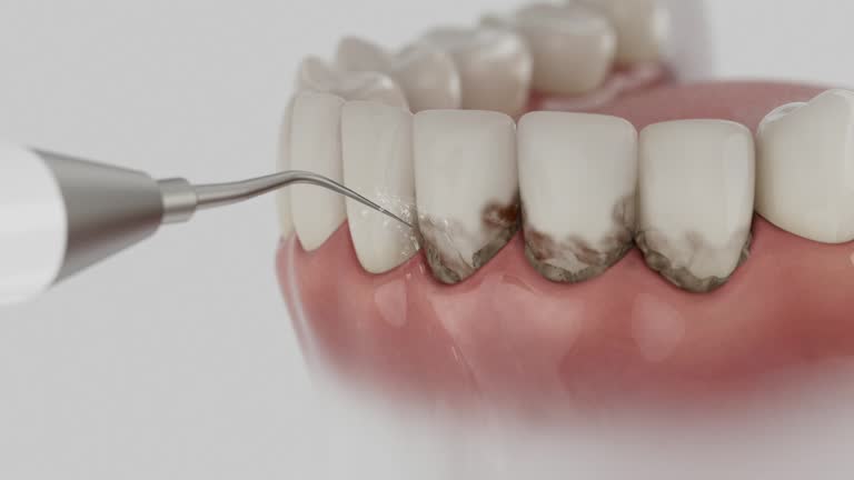 Trusted Wisdom Tooth Removal service in Moorpark, CA - Dentist Open Now